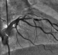 Angiogram